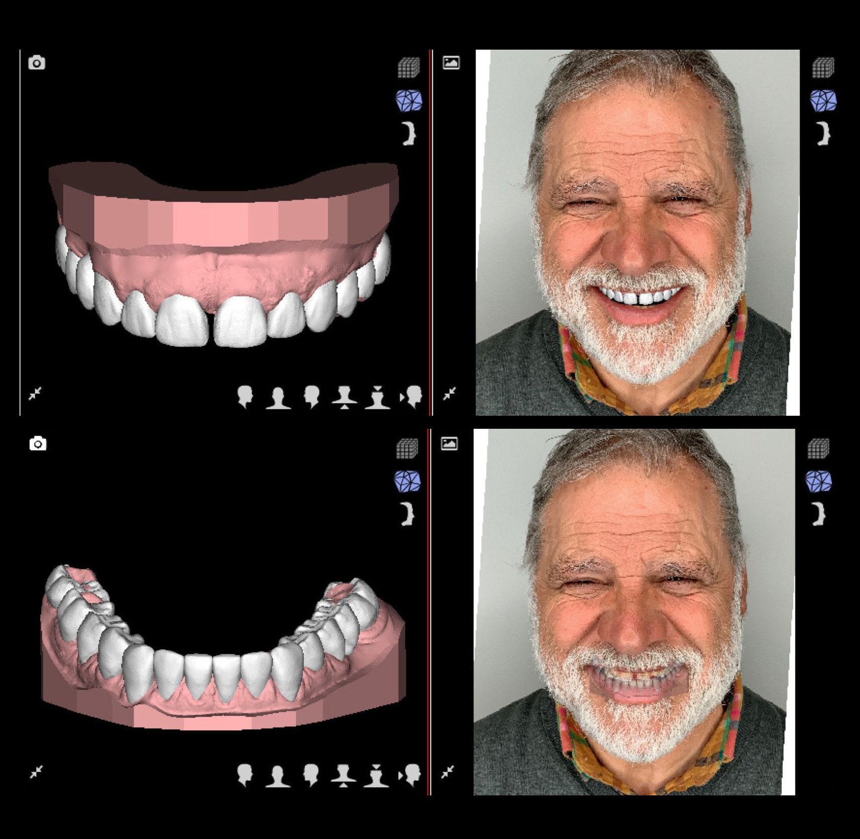 Escaner intraoral en clinica dental proboca cantabria