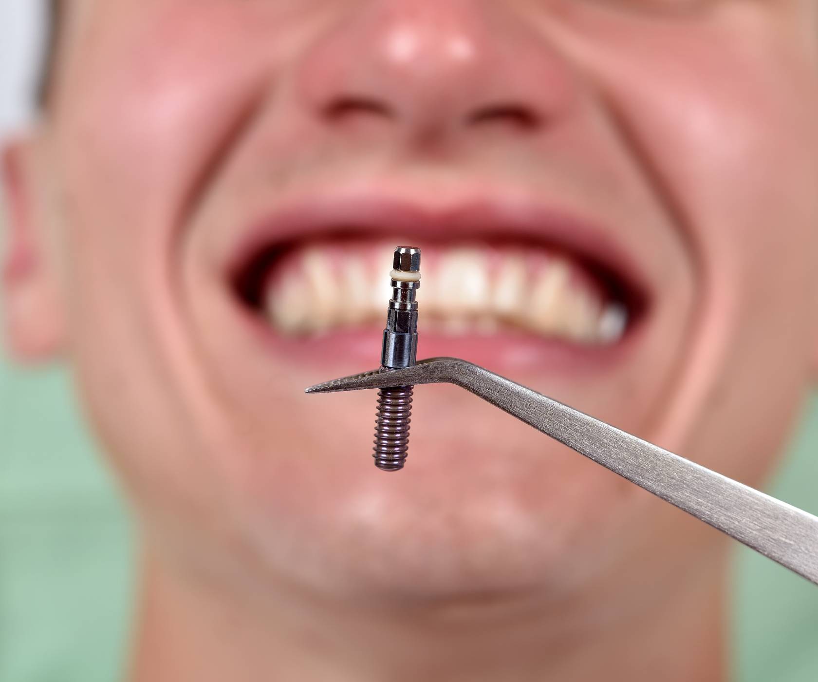Escaner intraoral en clinica dental proboca cantabria