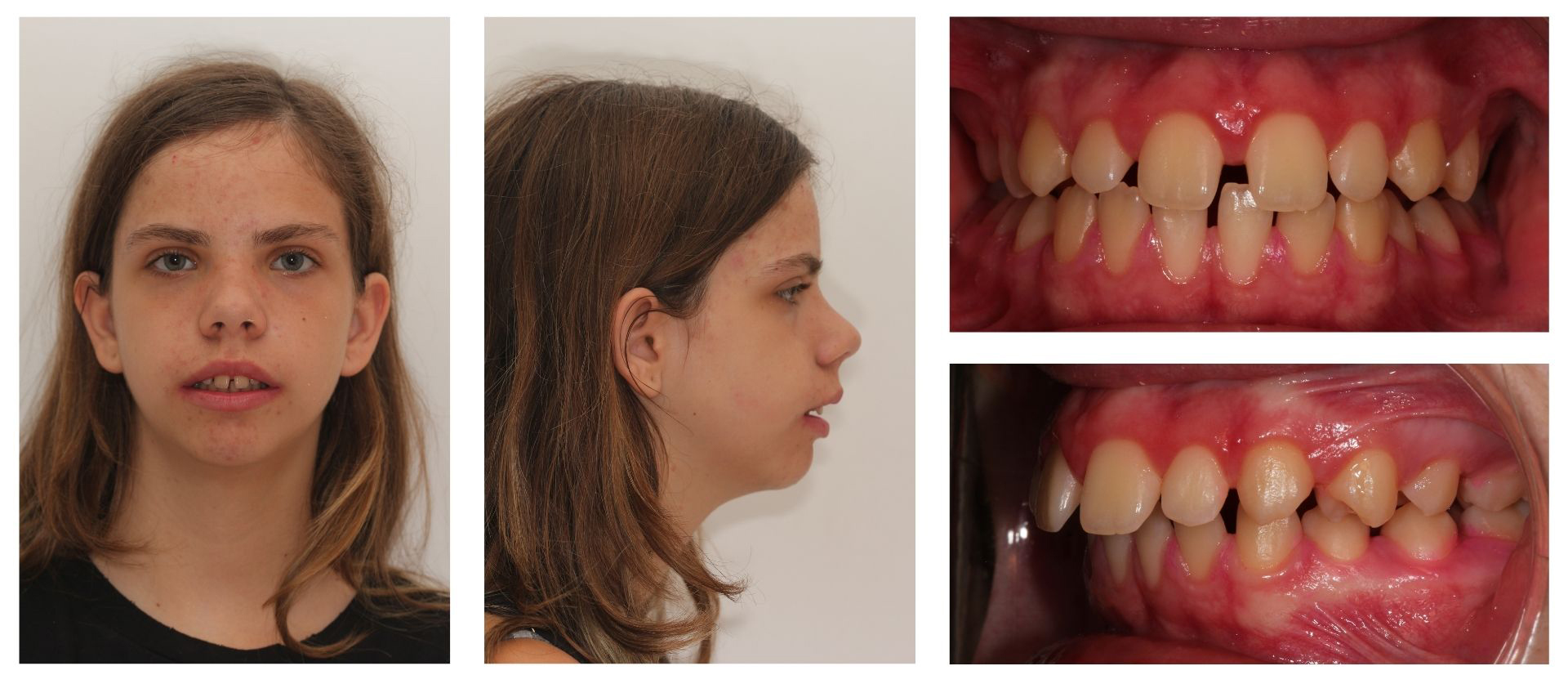 Diseño de sonrisa: Digitalizacion del estado de la boca