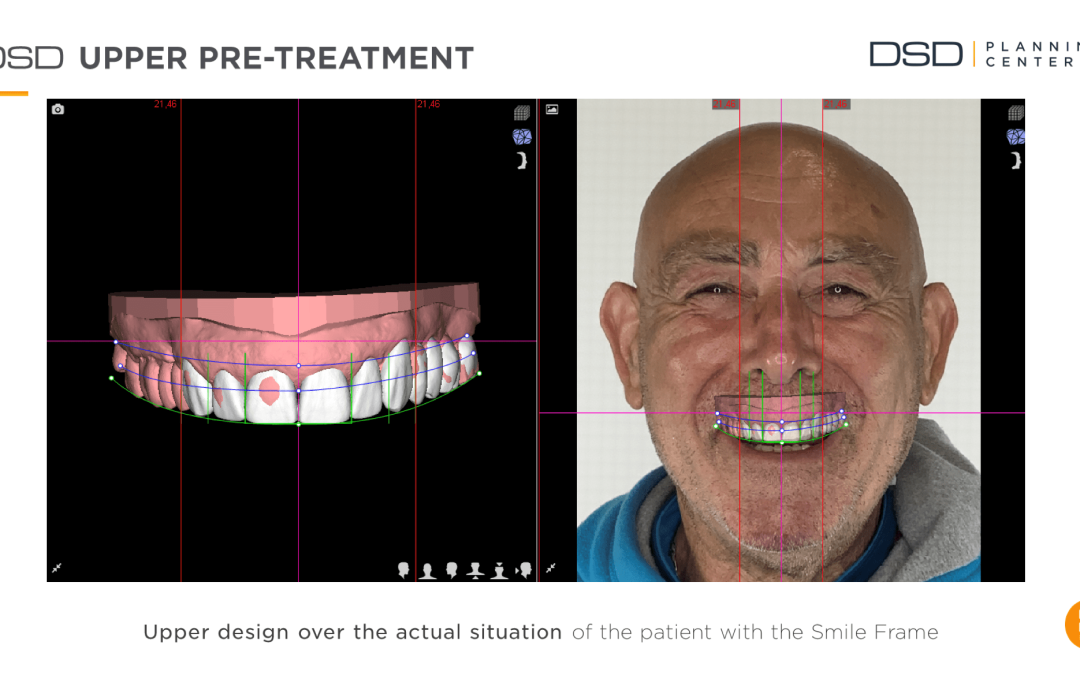 Tu clínica DSD en Santoña: Diseño de sonrisas y odontología emocional